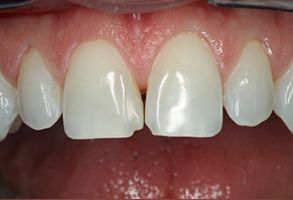 KayCare Family Dental | Preventative Program, Veneers and Teeth Whitening